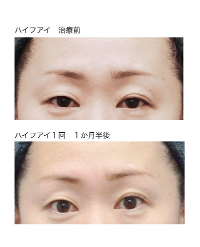 ハイフアイ 治療前・1か月半後