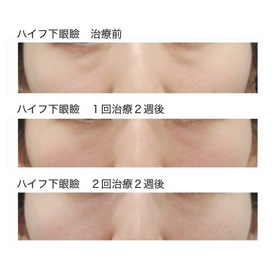 ハイフ下眼瞼 3段階