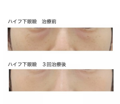 ハイフ下眼瞼 3回後